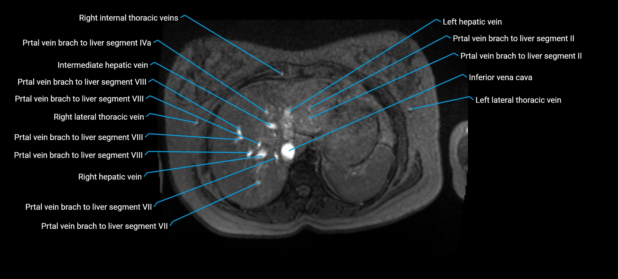 MRV abdomen pelvis & lower limb axial cross sectional anatomy labelled MRI image 29 (1).webp